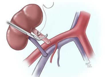 Dharmabhakta Hospital has performed 800 kidney transplants in the last nine years